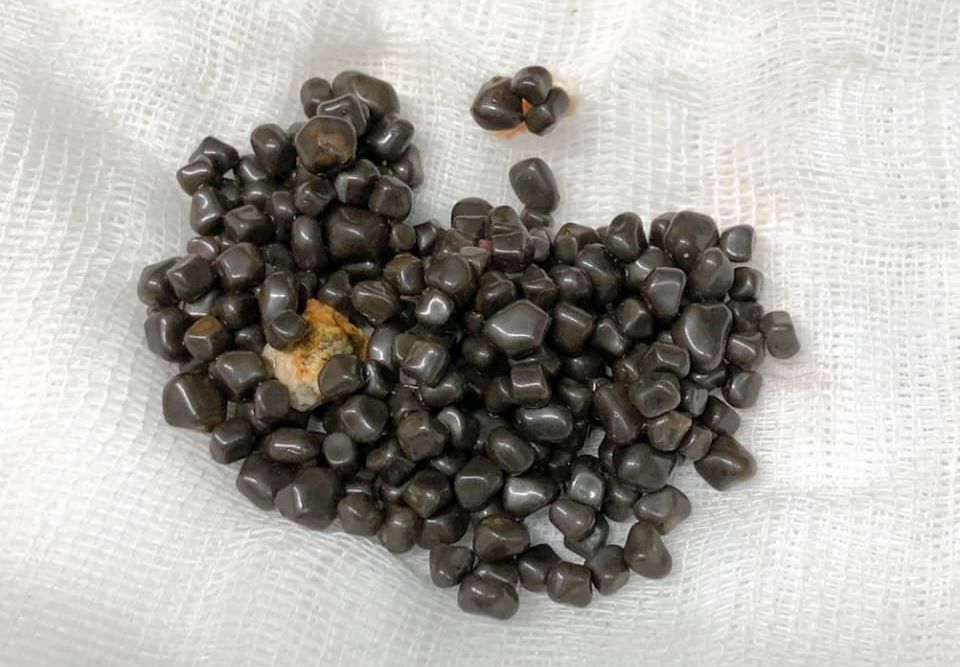 Желчнокаменная болезнь