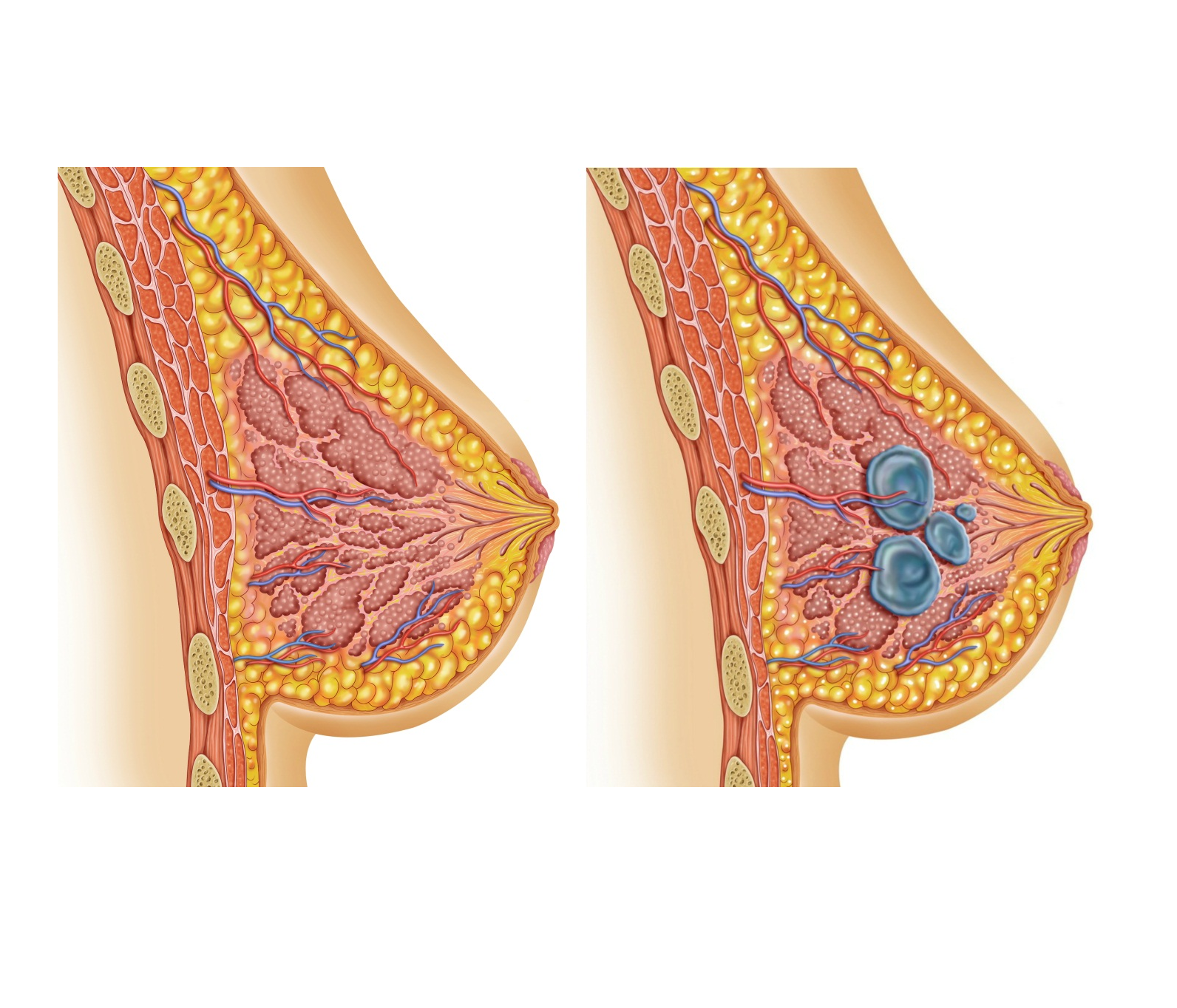 Мастопатия