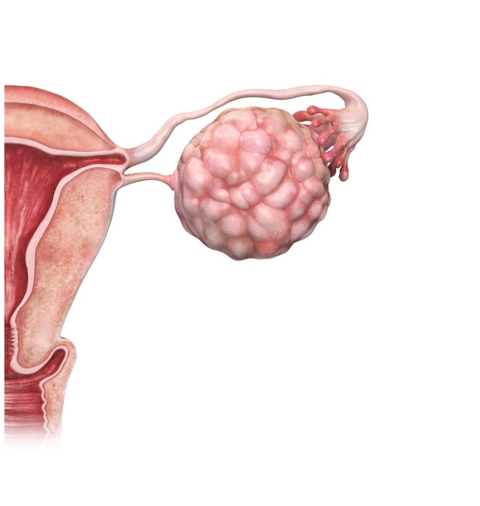 Синдром поликистозных яичников