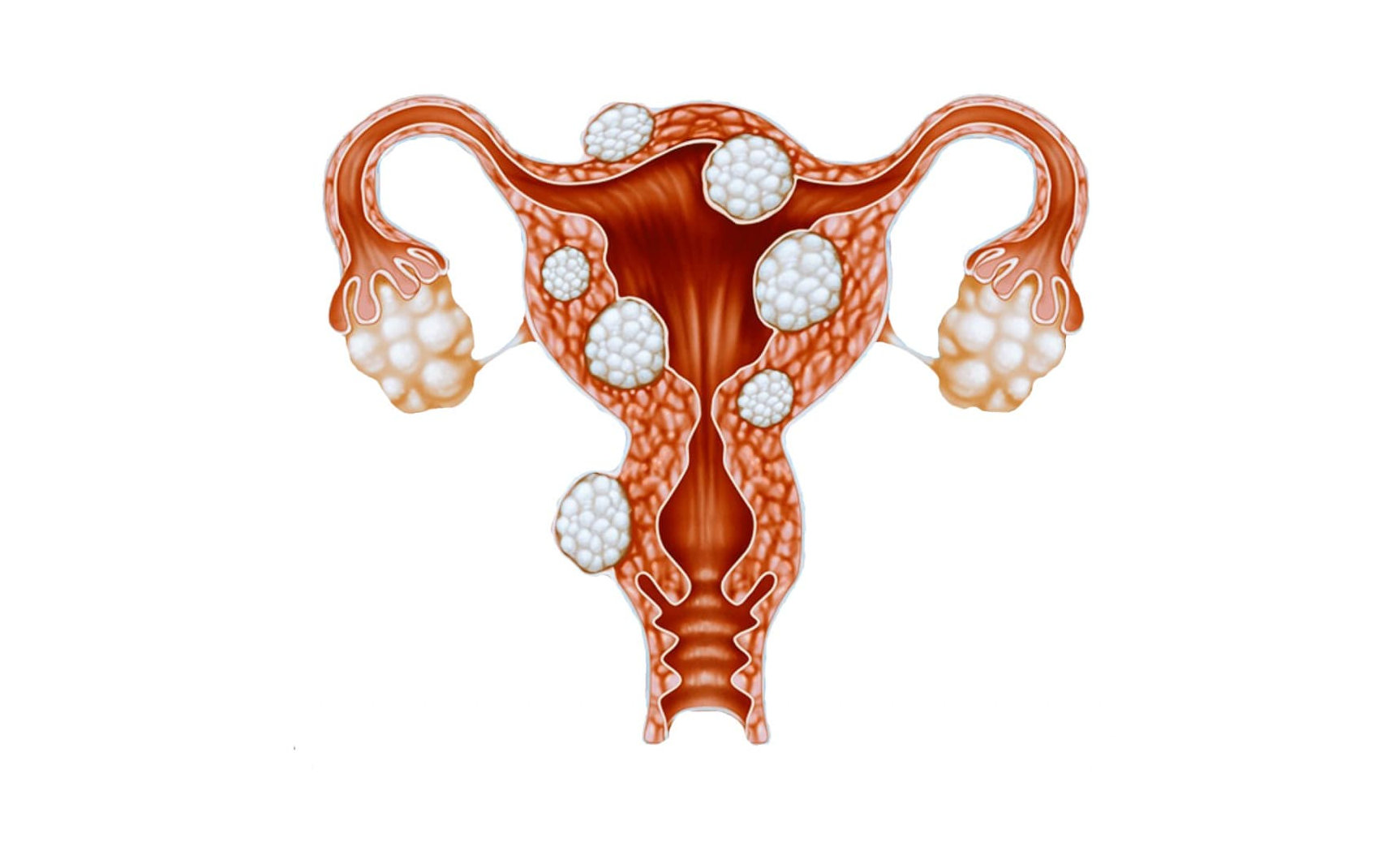 Миома матки