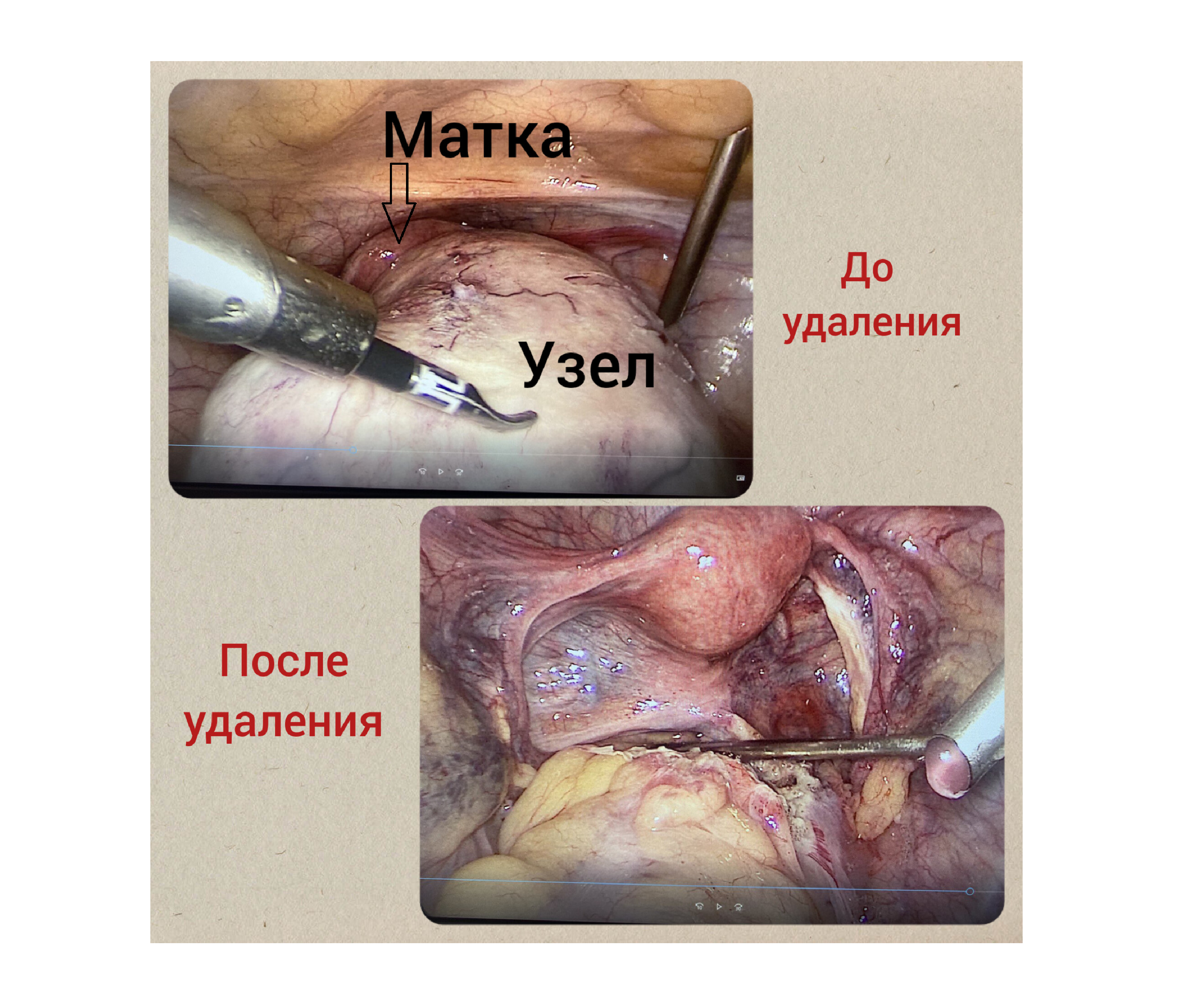 Врачи КГБУЗ «КМКБ № 4» спасли женщину, удалив редкую разновидность миомы матки/