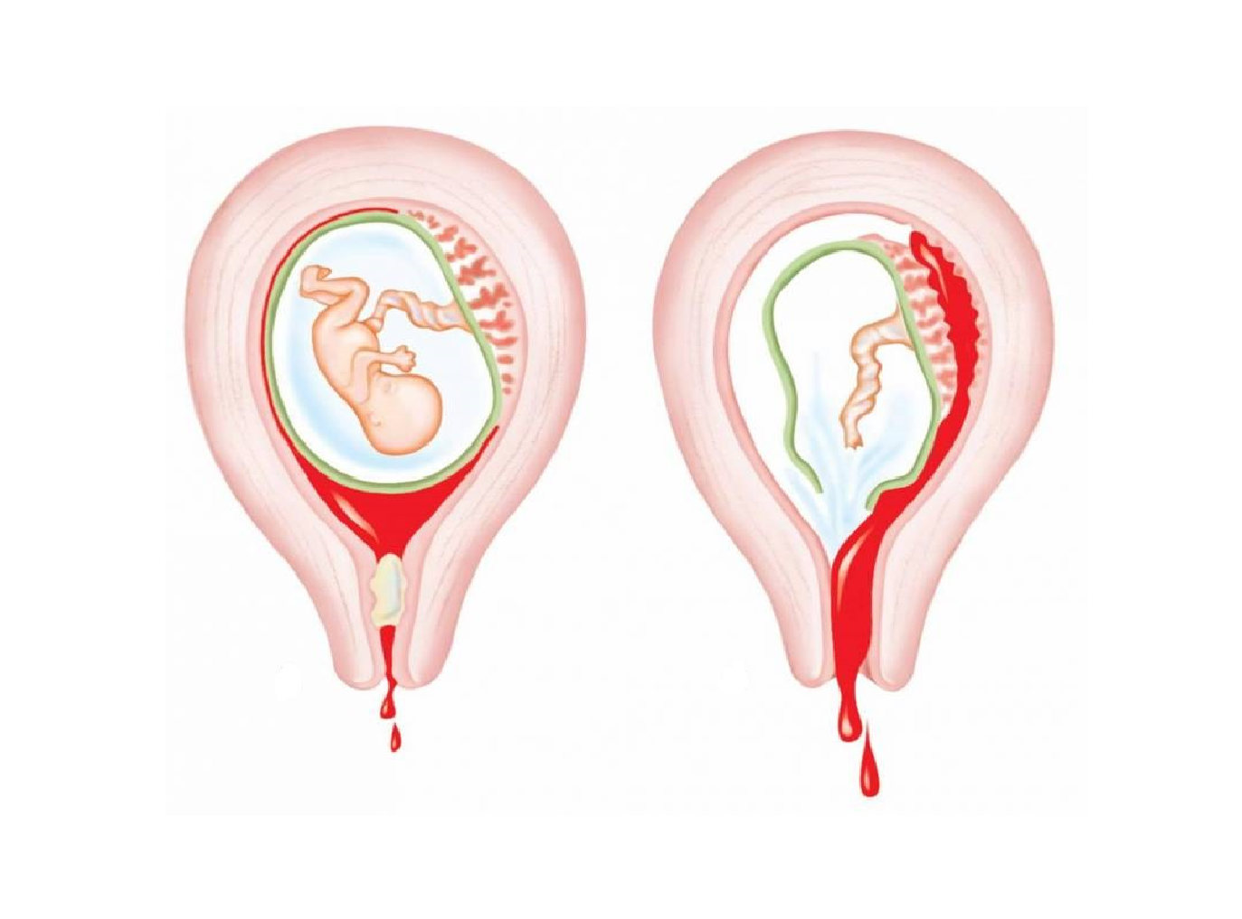 Невынашивание