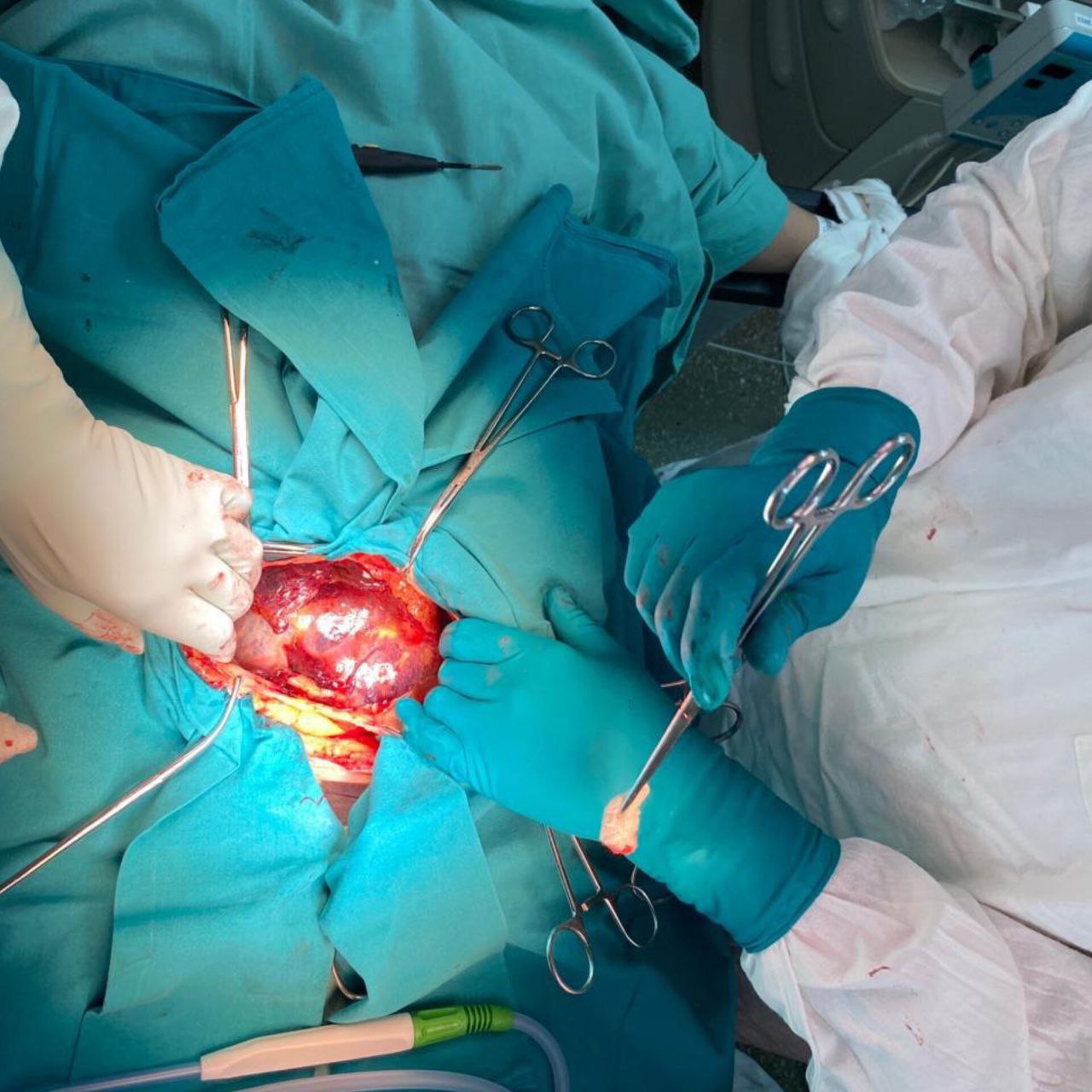 Специалисты Больницы на Кутузова спасли пациентку с редкой формой внематочной беременности