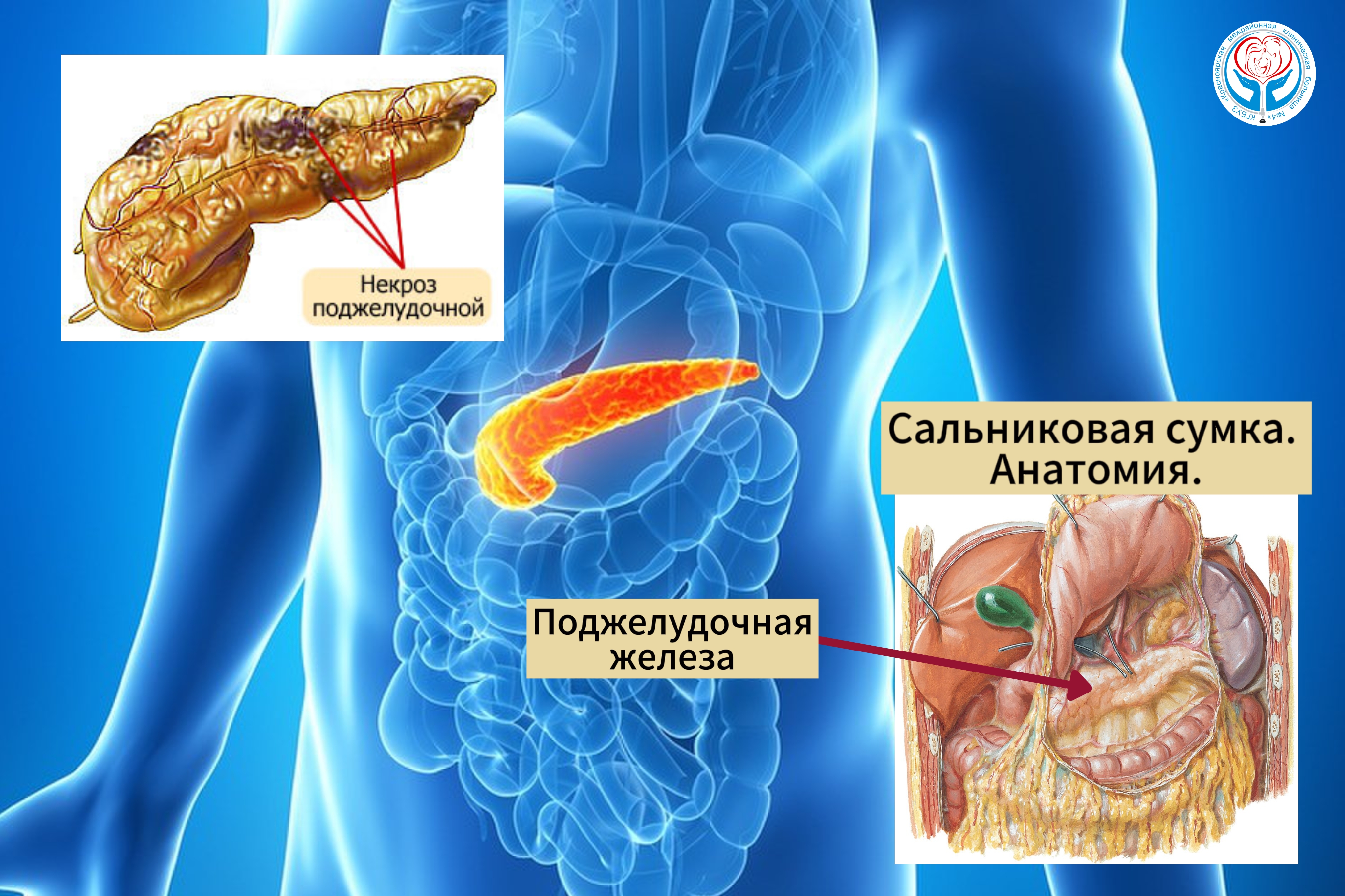 Врачи Больницы на Кутузова спасли пациента в крайне тяжёлом состоянии с диагнозом панкреонекроз