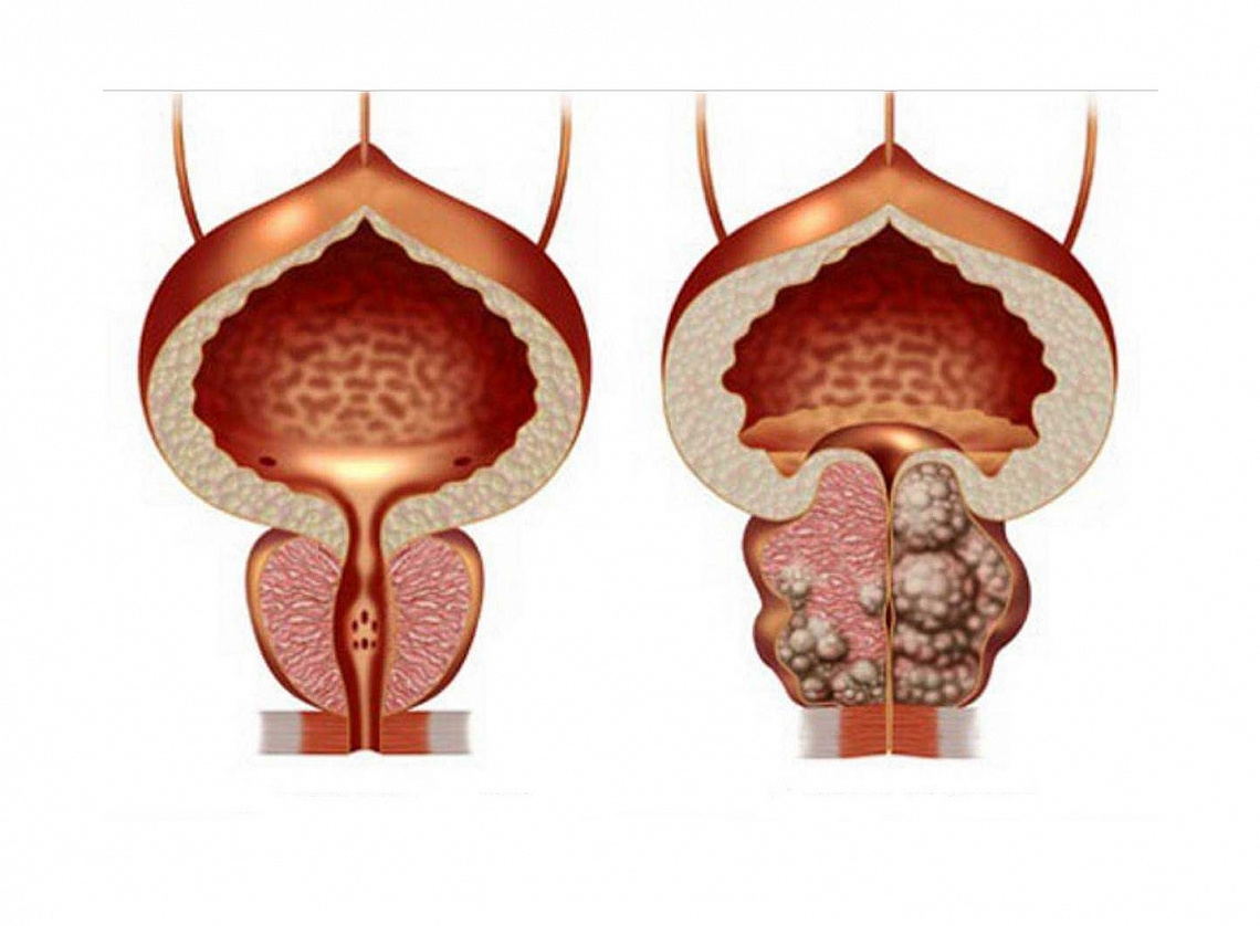 Аденома предстательной железы